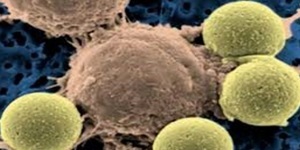 BMJ: Gut》細胞免疫療法的新技術帶來根治胰臟癌的曙光