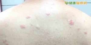 他背上紅疹不痛不癢 竟是皮膚淋巴癌